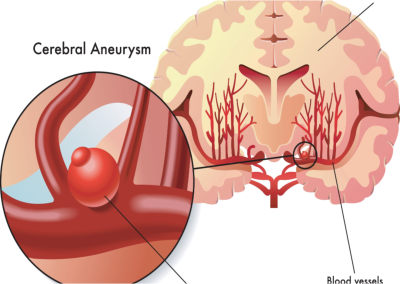 Cerebral Aneurism